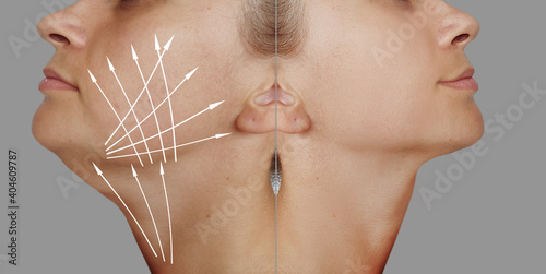 Φωτογραφία woman double chin before and after treatment