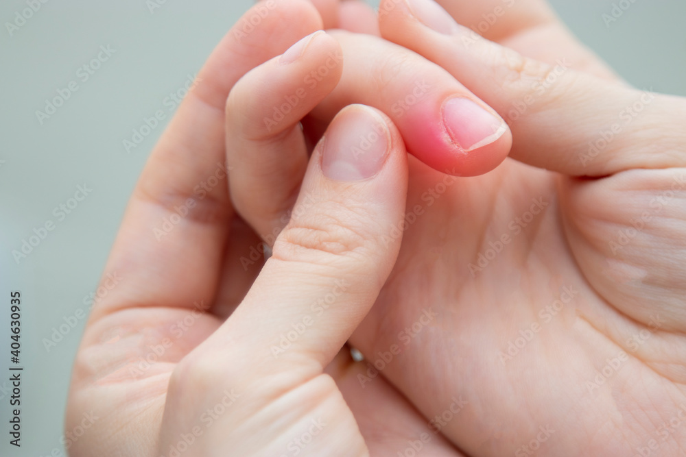 abscess on the finger. person with finger infection disease. fingernail pain. copy space. abscess on the finger. person with finger infection disease. fingernail pain. copy space.