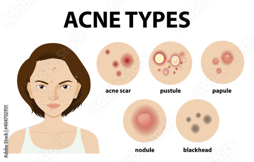Types of acne on the skin or pimples