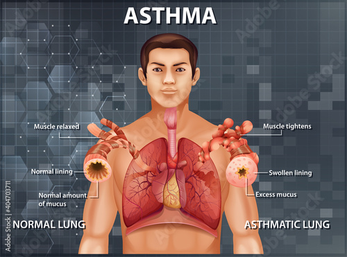 Comparison of healthy lung and Asthmatic lung