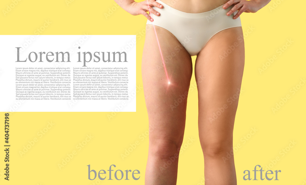 Φωτογραφία Legs of young woman before and after treatment by laser on color background with