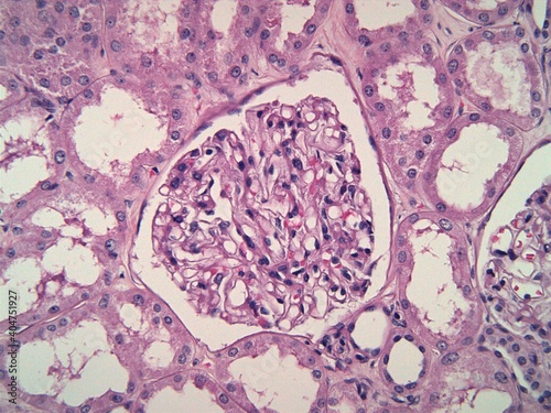 Kidney biopsy showing a normal glomerulus composed of thin capillaries. The surrounding tissue is filled with renal tubules. Microscopic view. photo