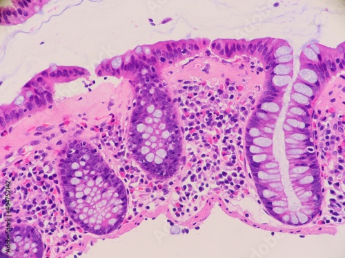 Colon biopsy showing a thickened collagen layer underneath the degenerating surface epithelium. This is a microscopic colitis called collagenous colitis. Microscopic view. photo