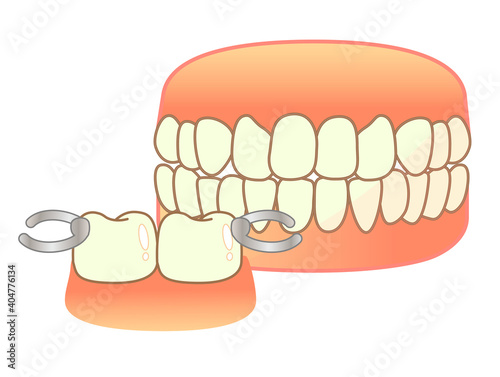 Denture Illustration Set: Denture Illustration
