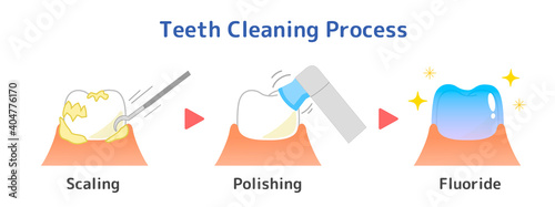 PMTC:Professional Mechanical Tooth Cleaning  Dental Illustration