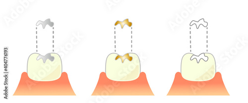 Dental Inlay Caries and Progression and Treatment: Dental Illustration