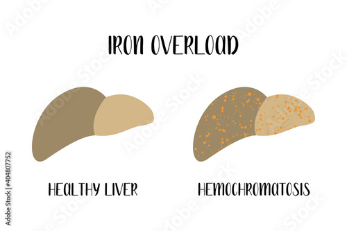 Iron overload. Healthy liver and  hemochromatosis. Hepatology. Diagnosis of liver diseases. Vector flat illustration. Perfect for flyer, medical brochure, banner