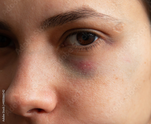 hematoma under the eye on the skin as a background photo