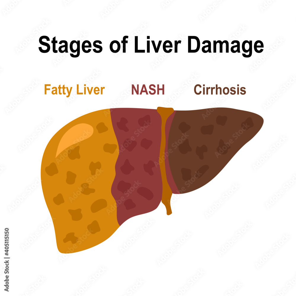 Stage of liver damage fatty liver, NASH and cirrhosis in flat design