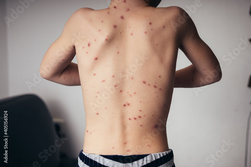 chickenpox in a child, rash. selective focus