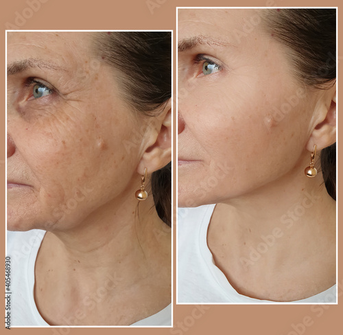 Slika na platnu woman face wrinkles before and after treatment