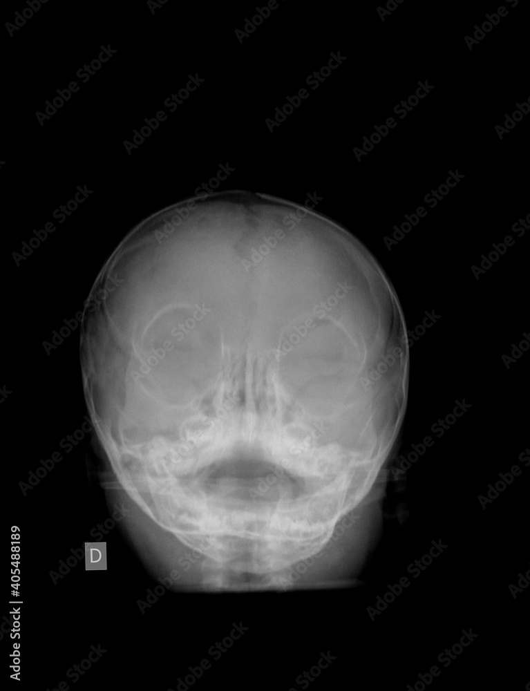Head xray image of the baby film.The scan show normal child skull