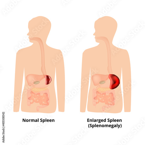Splenomegaly of the spleen. Enlargement of the spleen. Vector illustration on isolated background