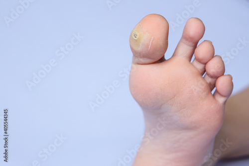 close-up of plantar wart.