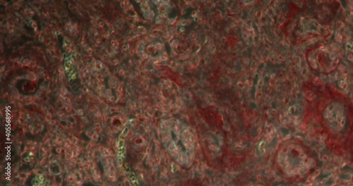 cirrhotic kidney tissue in Darkfield tissue under the microscope 200x photo