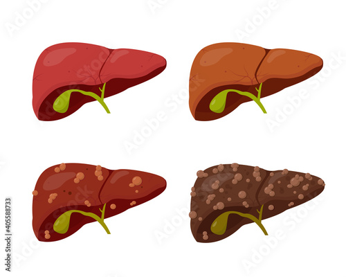 Human liver set. Stages of liver Disease.