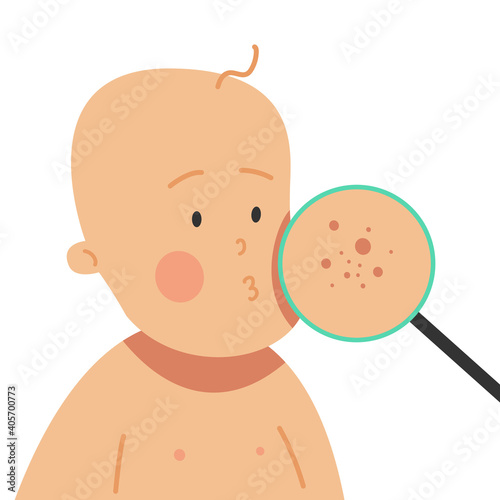 Child with skin allergies. Acne, atopic diseases, itching, dry skin, rashes, epidermis, dermatology and more. Advanced care.