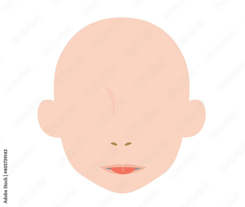 舌小帯短縮症で伸ばせない舌のイラスト　