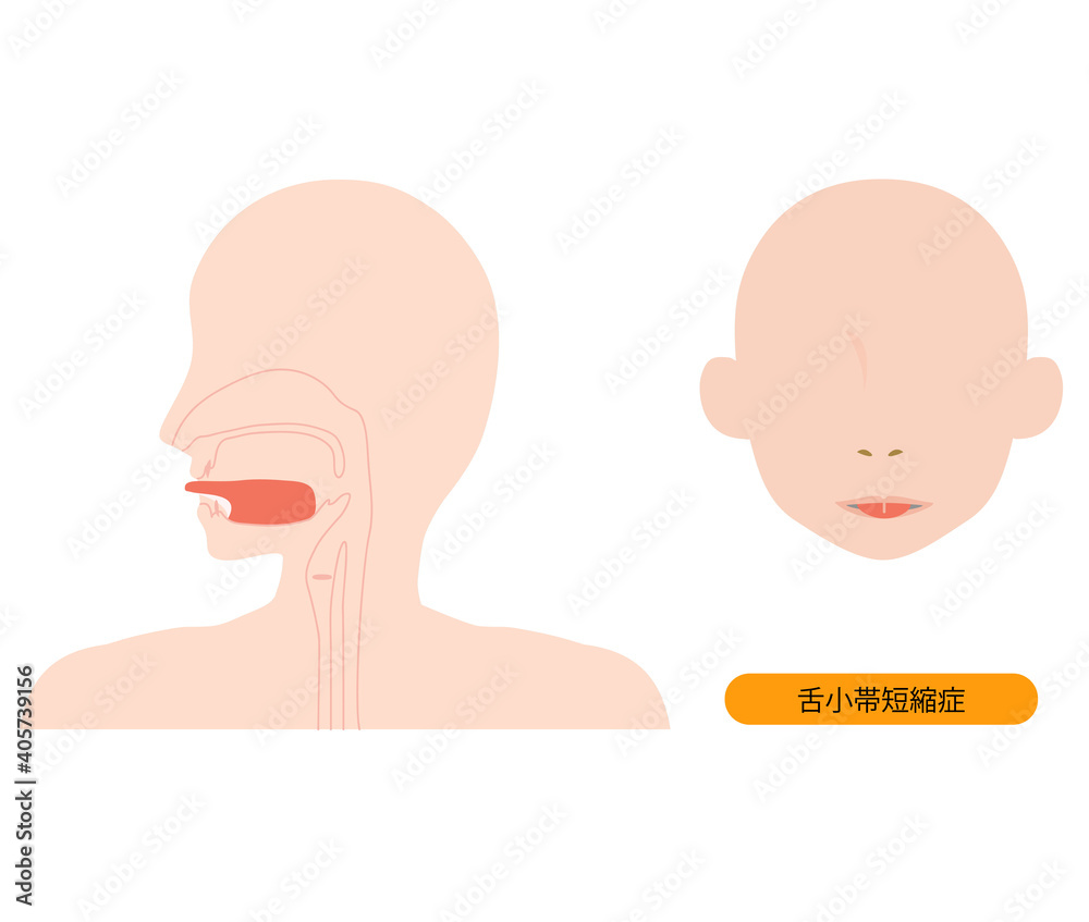 舌小帯短縮症で伸ばせない舌のイラスト 舌小帯短縮症で伸ばせない舌のイラスト