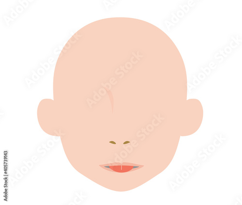 舌小帯短縮症で伸ばせない舌のイラスト　