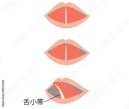舌小帯短縮症で舌を伸ばすとハート型になるイラスト