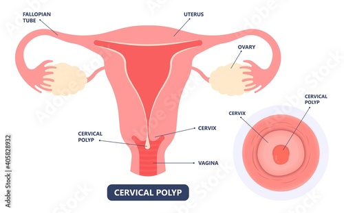 womb cancer level hormone Heavy Bleeding fertility problem infertility block tube cervix pain infection inflammation biopsy lining tumor cyst Surgical removal sessile pedicle menstruation and blood