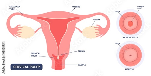 womb cancer level hormone Heavy Bleeding fertility problem infertility block tube cervix pain infection inflammation biopsy lining tumor cyst Surgical removal sessile pedicle menstruation and blood