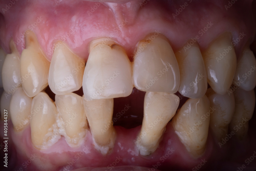human teeth, teeth ache needs to be treated.