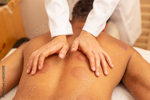Close em mãos de terapeuta fazendo massagem em costas de paciente que está com marcas de ventosa.