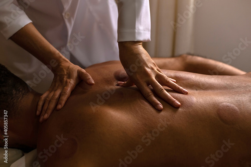 Mãos de terapeuta fazendo massagem em costas de paciente com marcas de ventosas.