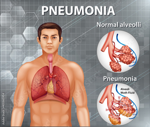 Comparison of healthy alveoli and Pneumonia
