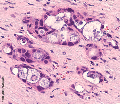 Cancer of Esophagus: Moderately differentiated invasive adenocarcinoma arising in a patient with Barrett's (intestinal) metaplasia related to acid reflux.  