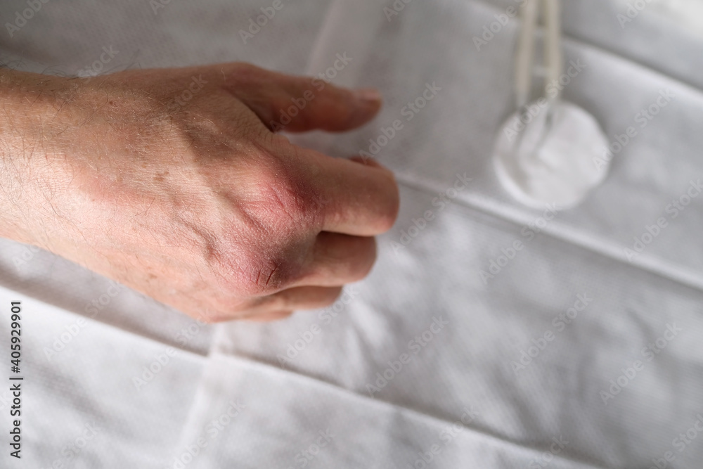 Close up of male hands with dry skin damage. nurse treats wounds. Dermatology concept