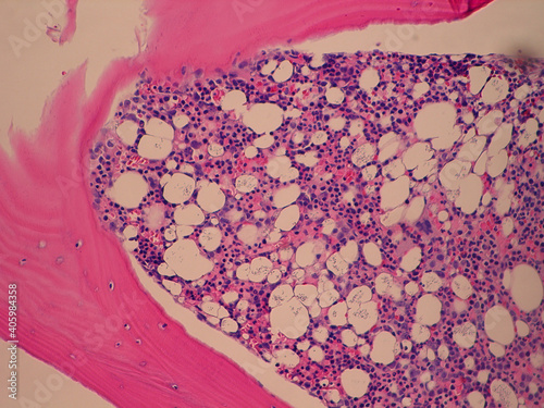 Bone marrow core biopsy pathology - disseminated Histoplasma infection photo