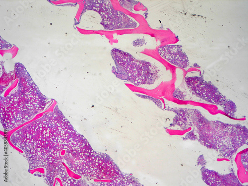 Bone marrow core biopsy pathology sections - H and E stain photo