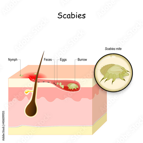 scabies mite photo