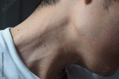 Many skin tags or Acrochordon on the neck of an Asian male. They are small soft and common benign on the human skin especially on adult skin and can be irritated by shaving and daily clothing