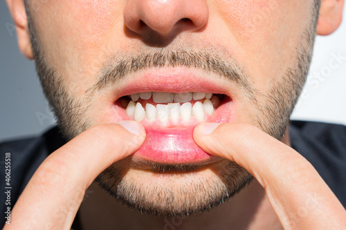 Young man crooked teeth. Reason to install teeth braces. Bad teeth photo
