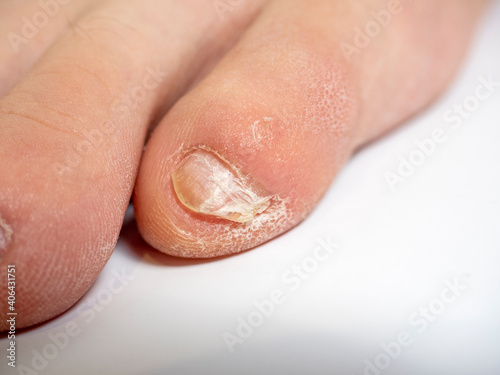 close-up of toes with nail problems. Infection, cracks, improper care. Nail care concept