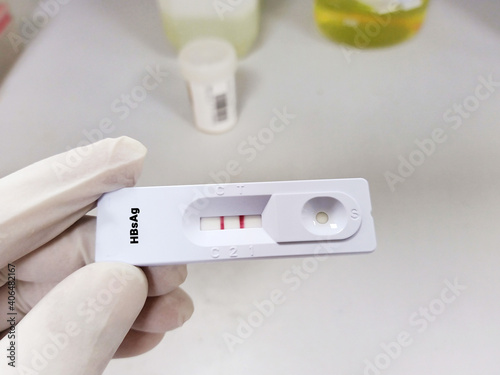 Biochemists or Lab Technologists hold rapid test cassette which shows Hepatitis B virus-positive results. Close View with laboratory background. Selective focus on the subject, background blur. photo