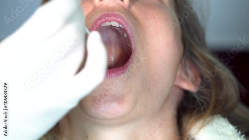 
A nurse wearing latex gloves inserts a swab down a woman's throat to collect a possible positive COVID-19 sample during the pandemic. Antigen test procedure.