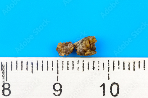Murais de parede Oxalate stone, extracted from the kidney