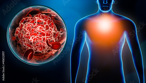 Canvas Print Man suffering chest pain due to embolism or embolus with blood clot or thrombus image 3D rendering illustration