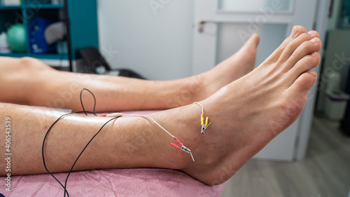 Macro shot of needles with electricity inside the ankle. patient with sprained ankle