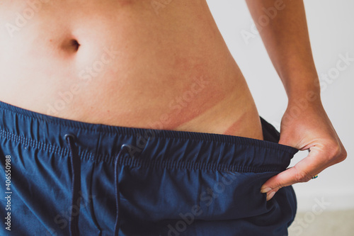 sun exposure and sunscreen use, girl revealing intense tan lines on her hips