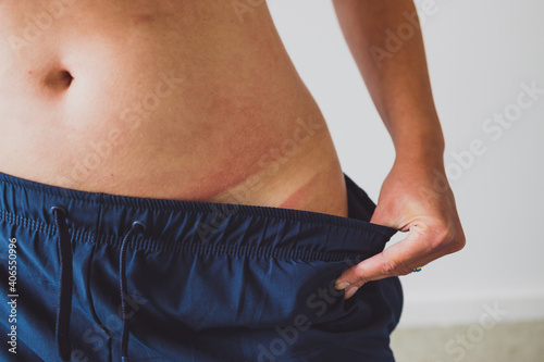 sun exposure and sunscreen use, girl revealing intense tan lines on her hips