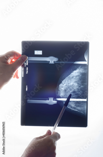 Cropped hands of medical woman examining mammogram X-ray of right breast with cysts on white background. Craniocaudal view.  photo