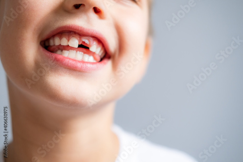 Fotografia Boy without milk upper tooth in white t-shirt smiling on the gray background