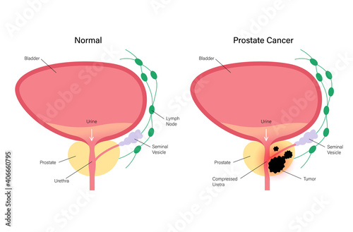 Prostate cancer concept