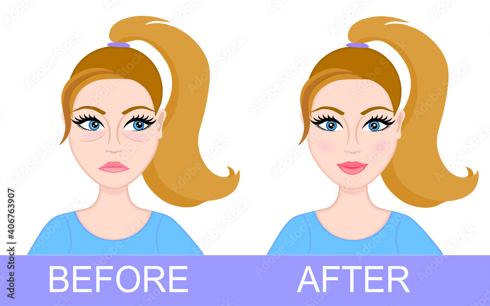 Plastic surgery of eyelids, operation removal of bags under eyes